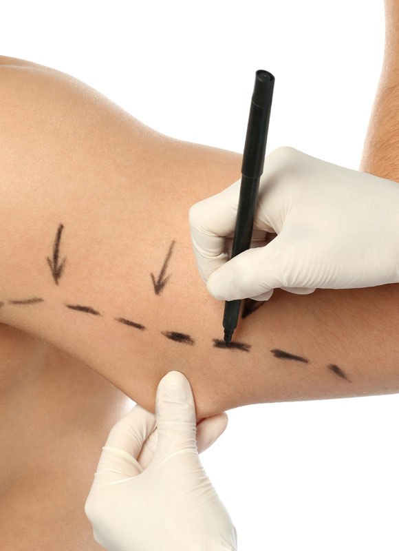 Northwood Hospital - Arm Lift The Procedure