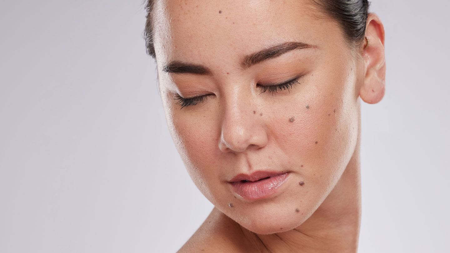 Northwood Hospital - Mole Removal