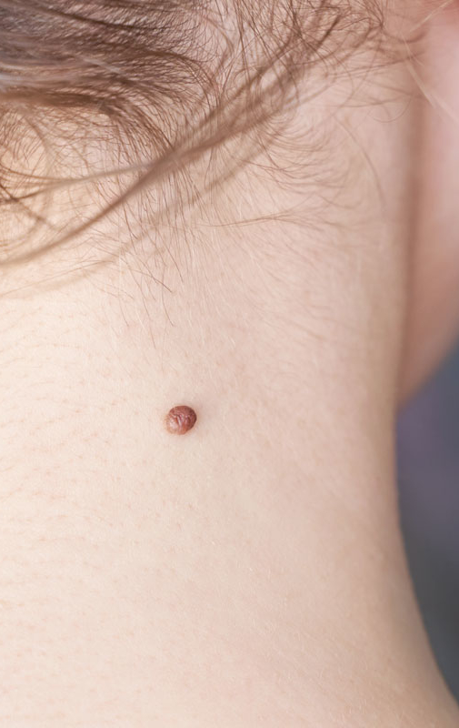 Northwood Hospital - Mole Removal Procedure Overview