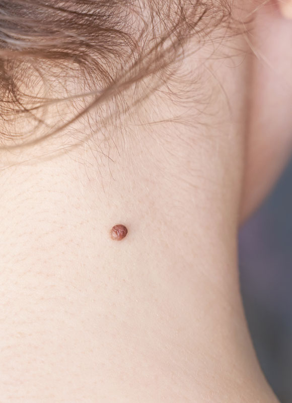 Northwood Hospital - Mole Removal Procedure Overview