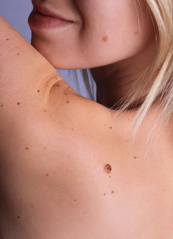 Northwood Hospital - Mole Removal The Procedure