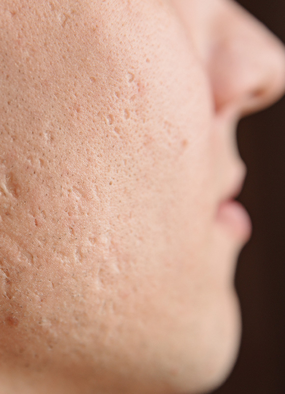 Northwood Hospital - Poor scars