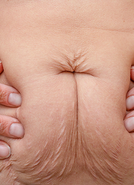 Northwood Hospital - Excess skin from weight loss