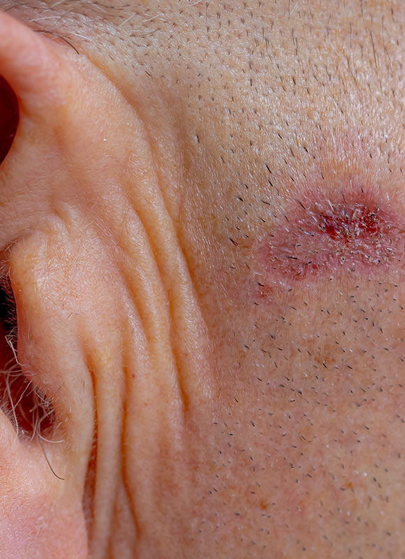 Northwood-Treatment-BCC-Excision-Consultation