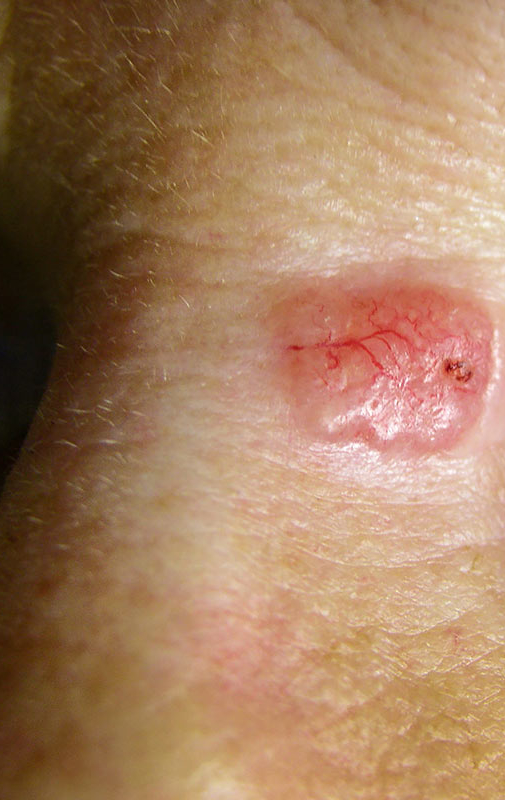 Northwood-Treatment-BCC-Excision-Intro