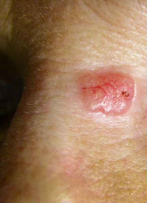 Northwood-Treatment-BCC-Excision-Intro