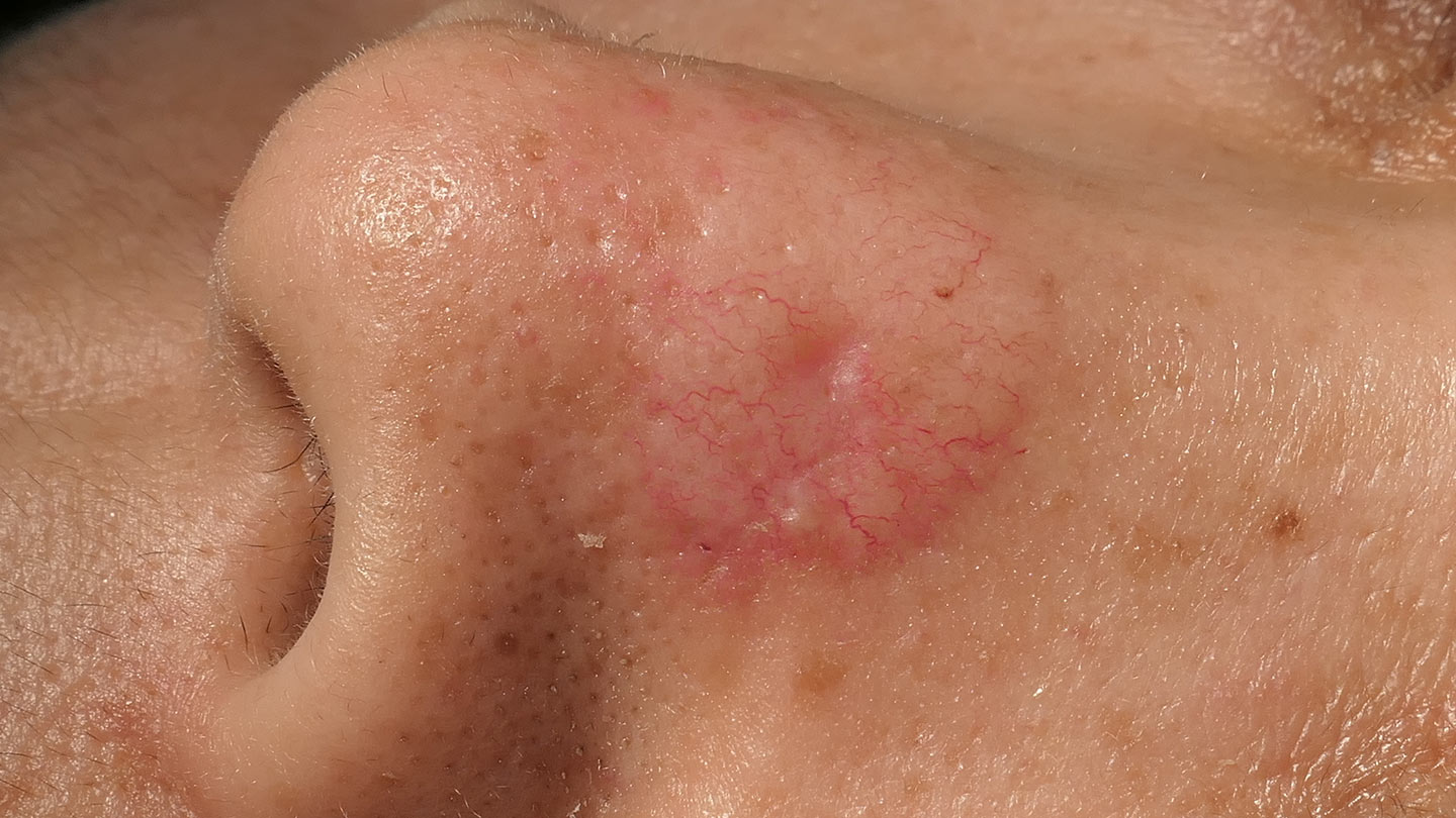 Northwood Hospital - BCC Excision