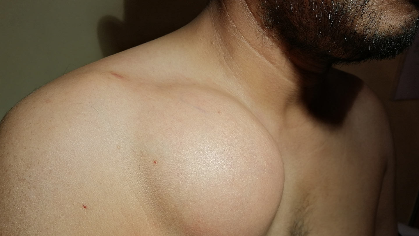 Northwood Hospital - Lipoma Removal