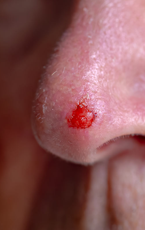 Northwood-Treatment-SCC-Excision-intro