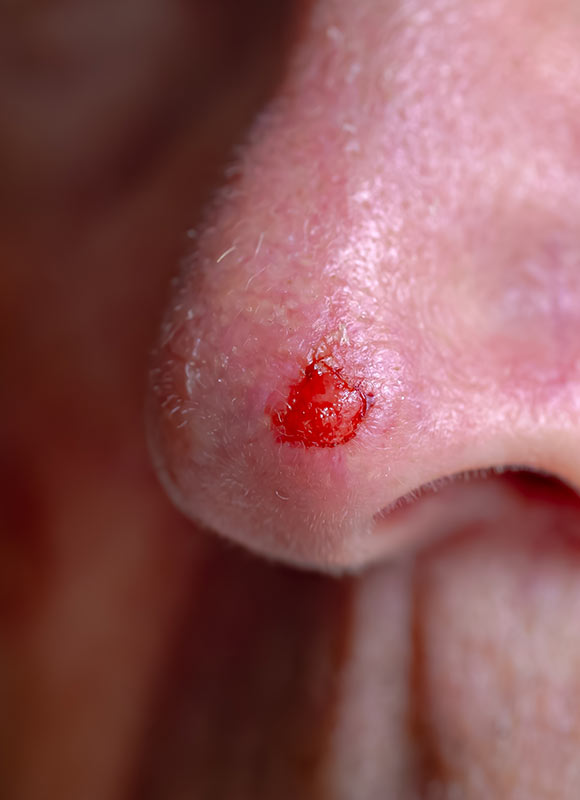 Northwood-Treatment-SCC-Excision-intro