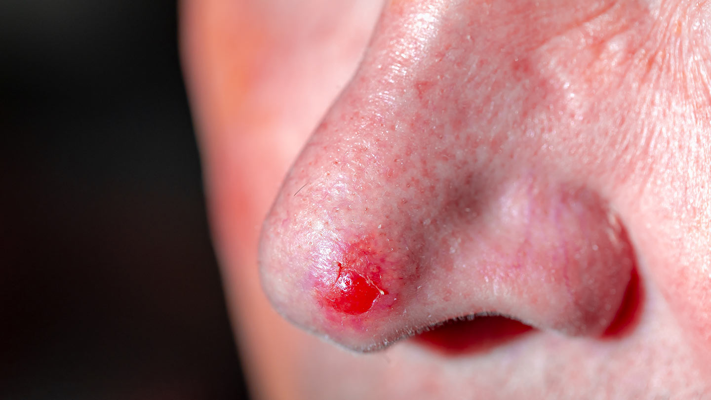 Northwood Hospital - SCC Excision